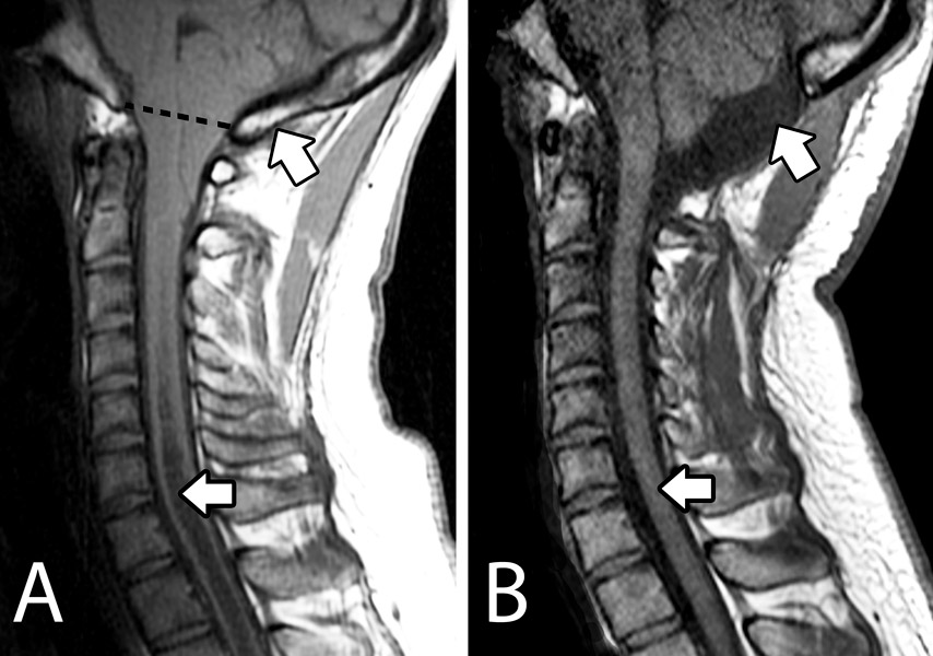 Chiari Malformation