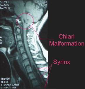 syringomyelia spinal cord