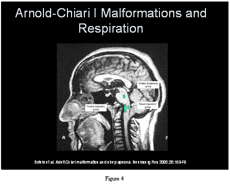 Chiari Malformation and Respiration