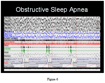 obstructive sleep apnea