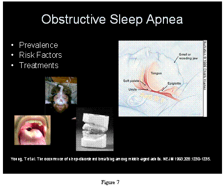 obstructive sleep apnea