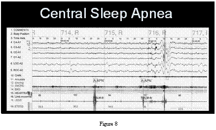 central sleep apnea